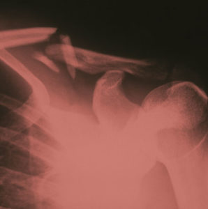 Shoulder X-Ray - Auto Accident Injury Lawyer - Domnitz & Domnitz of Milwaukee